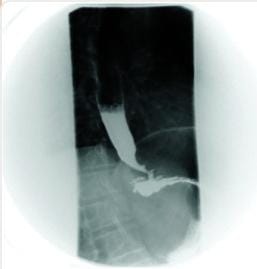 Type 1 Achalasia cardia manometry show absent esophageal peristalsis