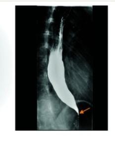 Type 2 of Achalasia cardia