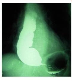 Type 3 Achalasia cardia