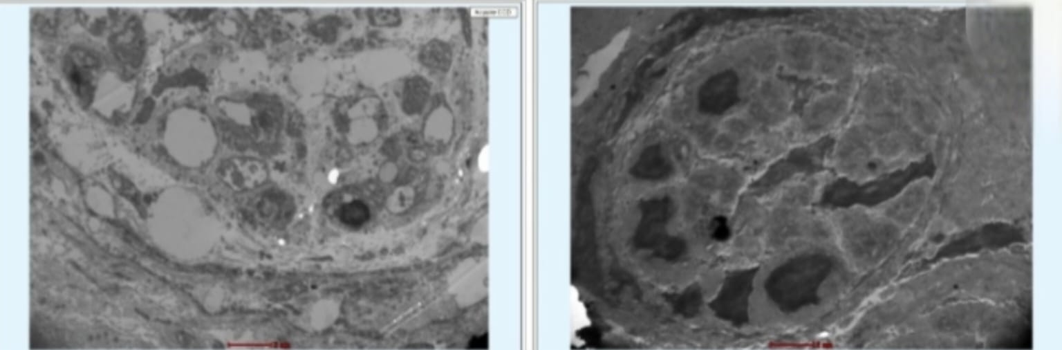 Myenteric plexus degeneration of Achalasia cardia