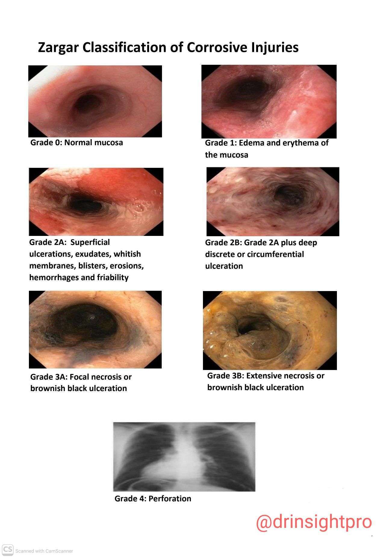zargar classification of corrosive intake