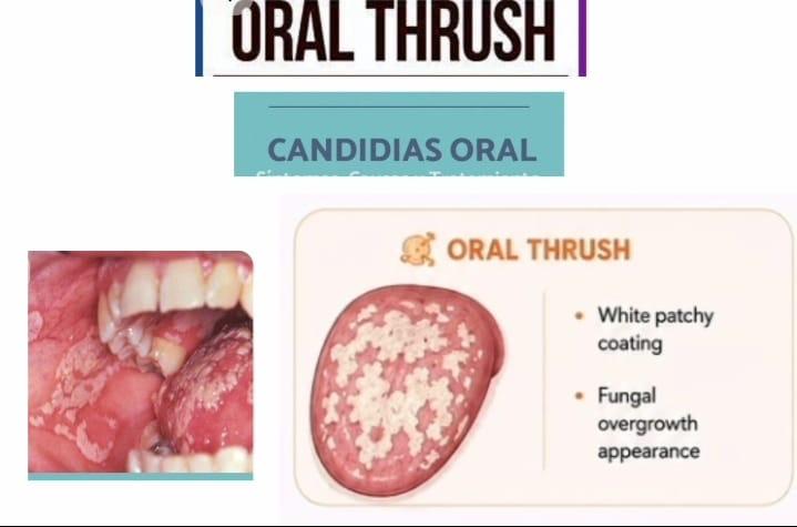 Oral thrush infection showing white patches on tongue