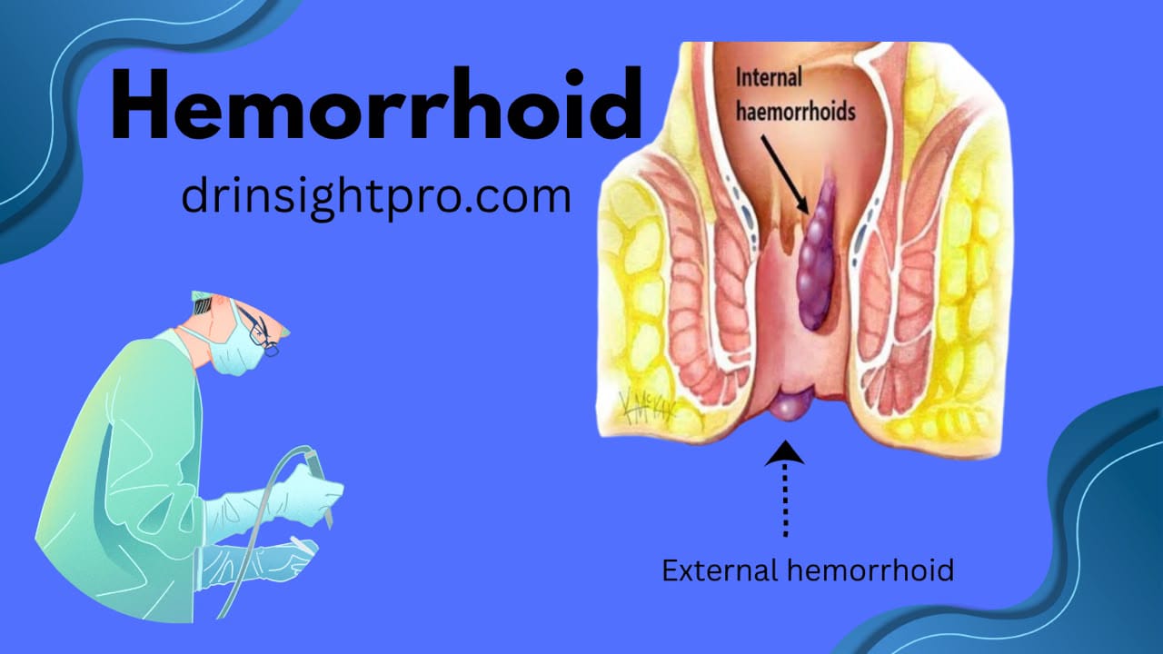 Featured image for a hemorrhoid guide showing internal and external hemorrhoid anatomy with a doctor illustration, drinsightpro.com
