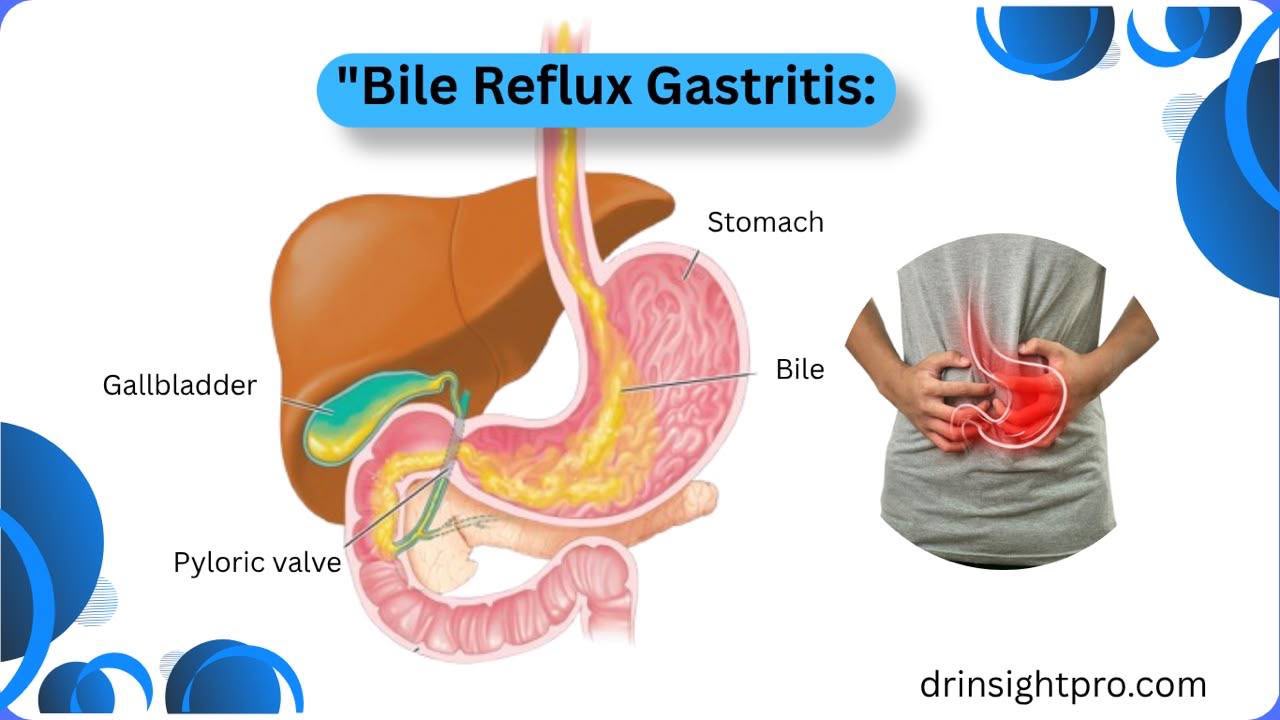 Bile reflux gastritis diagram showing stomach, gallbladder, bile flow and pyloric valve