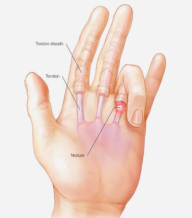 Medical illustration of hand anatomy showing trigger finger tendon, tendon sheath, and a nodule on the finger