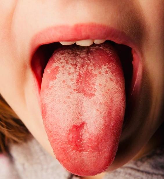 White patches on tongue caused by oral thrush infection