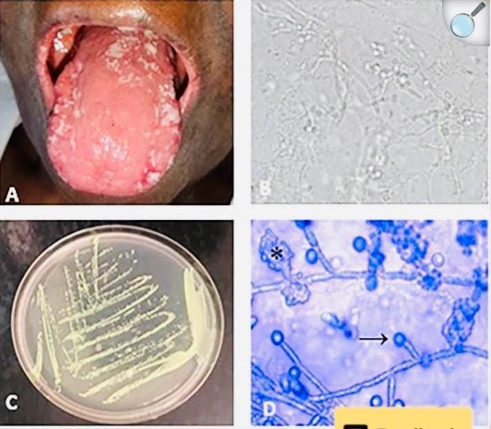 Candida albicans fungal culture under microscope for oral thrush diagnosis