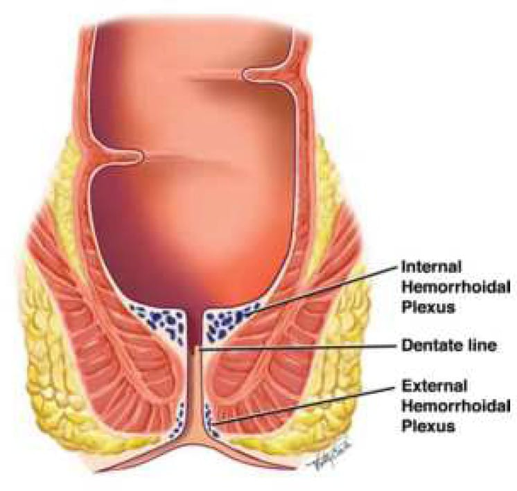 Diagram showing internal hemorrhoids inside the rectum and external hemorrhoids near the anal opening