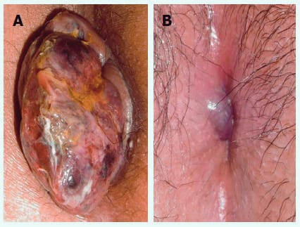 Endoscopic views of internal hemorrhoids at different stages inside the rectal canal