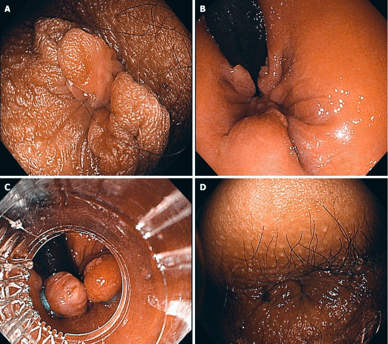 Endoscopic view showing a rubber band ligation device placed at the base of an internal hemorrhoid