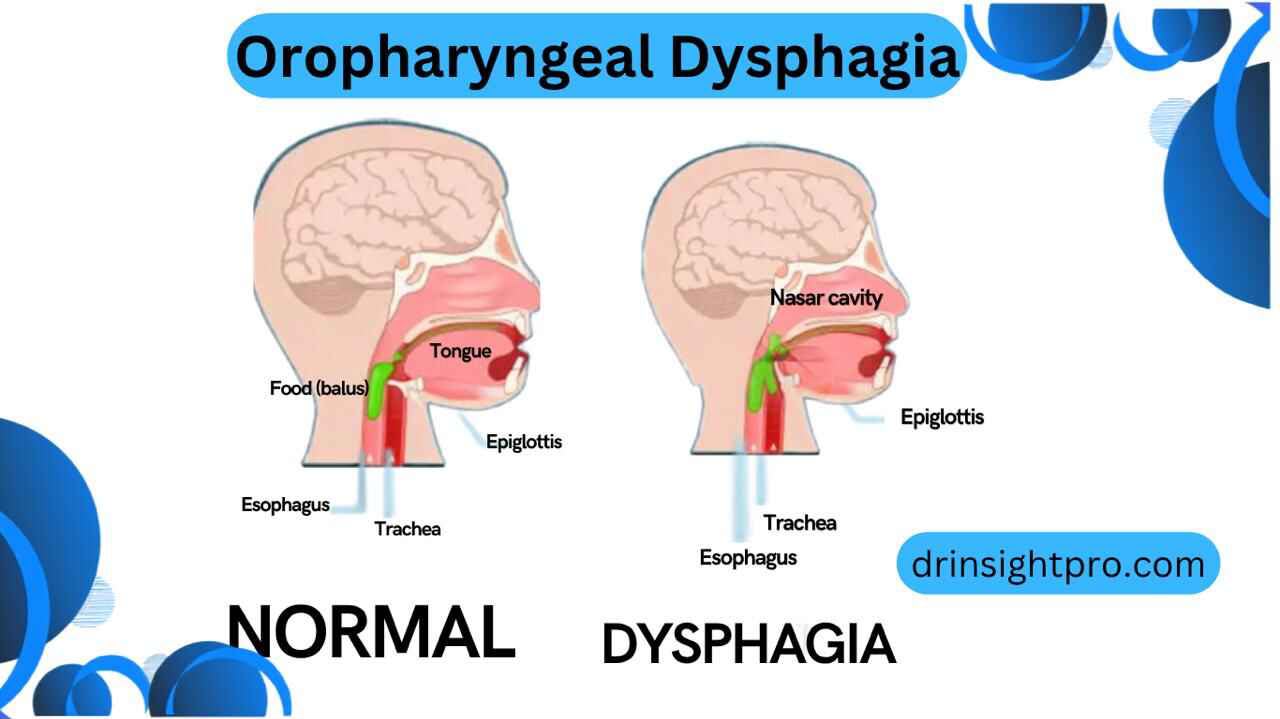 Medical illustration comparing normal swallowing and swallowing difficulty in oropharyngeal dysphagia
