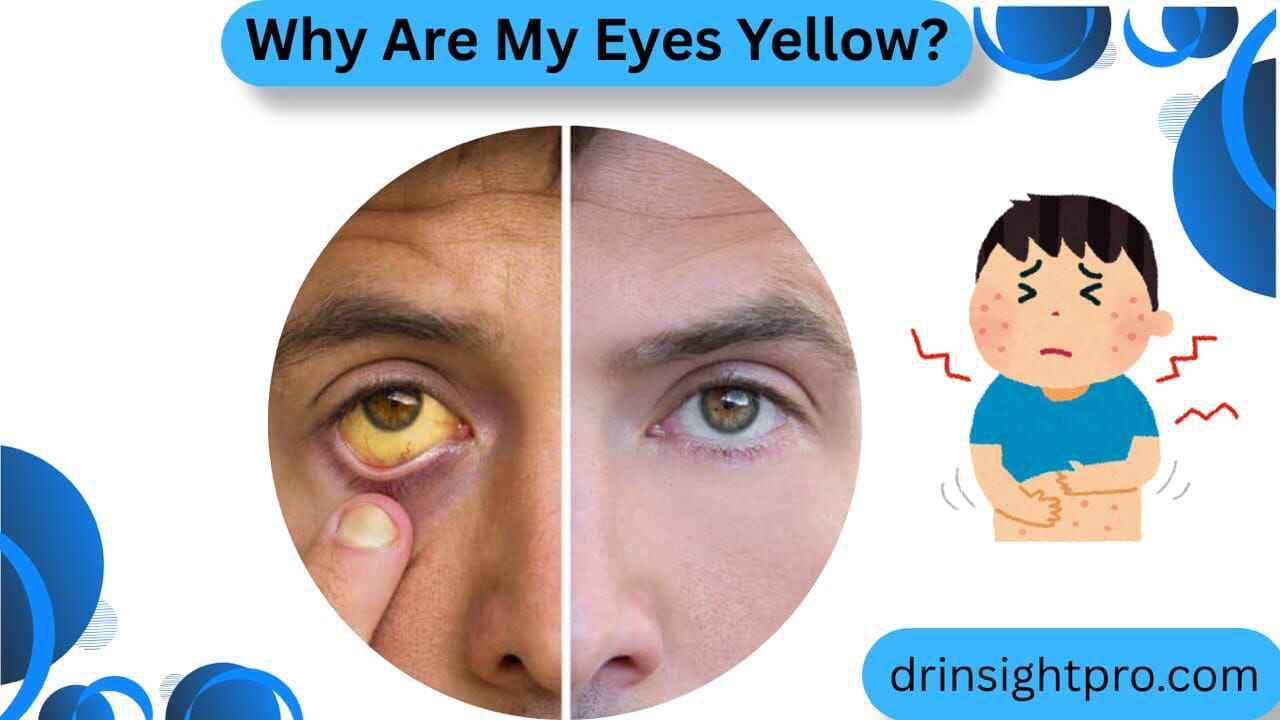 Yellow eyes (jaundice) compared with normal eyes