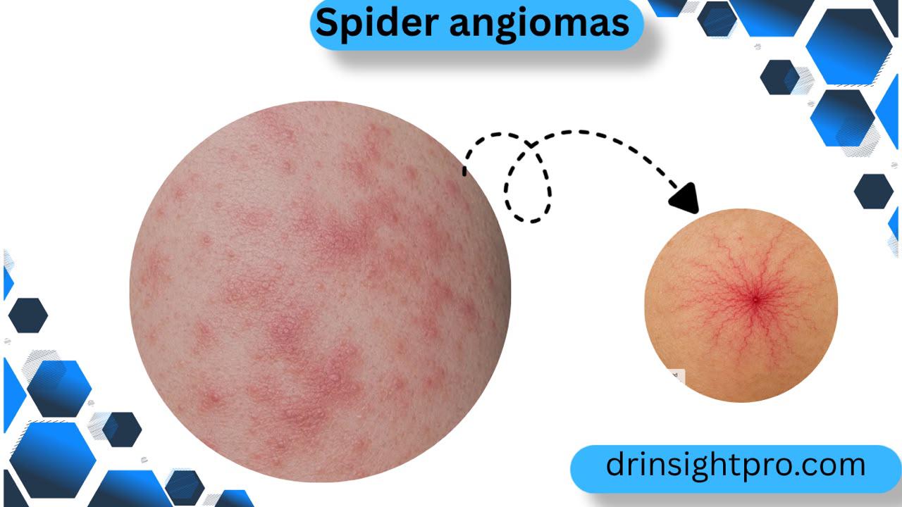 Infographic comparing generalized body rash and a close-up of a spider angioma lesion