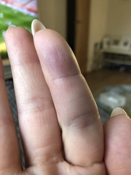 A finger with sudden dark purple-blue discoloration and bruising around the middle and distal portion.