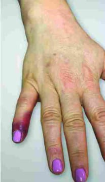 Close-up of fingers showing noticeable bluish-purple discoloration of one finger compared with the surrounding fingers.