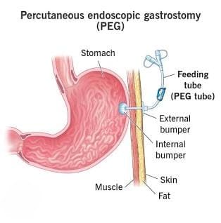 Anatomy of a Percutaneous Endoscopic Gastrostomy (PEG) placement.