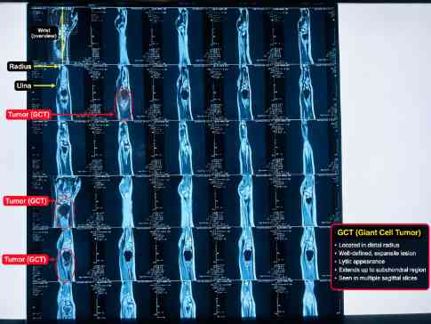 MRI showing Giant Cell Tumor [GCT]