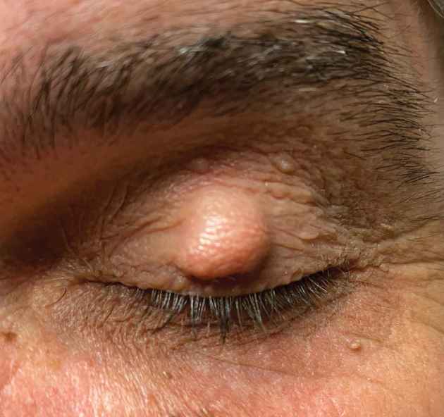 chalazion