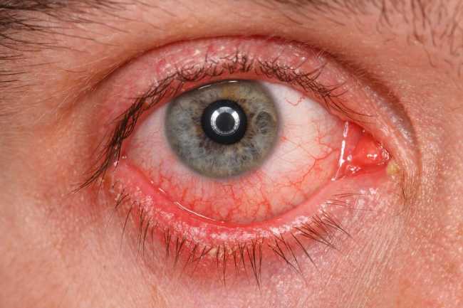 conjunctivitis/pink eye