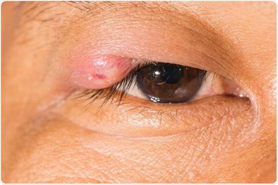 stye